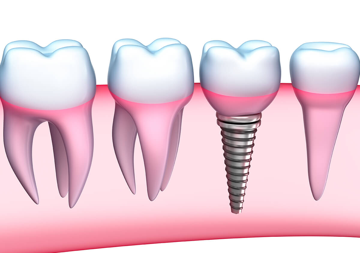 Implant Dentist in Oakland CA Area