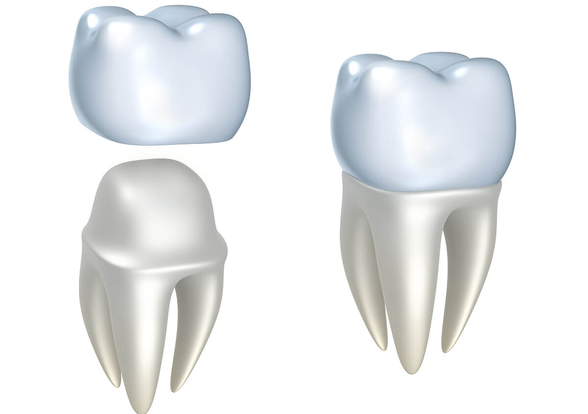 Natural Looking Dental Crowns in Oakland Area