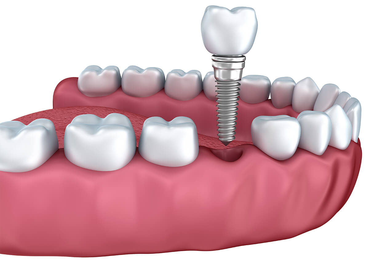 Teeth Implant in Oakland Area