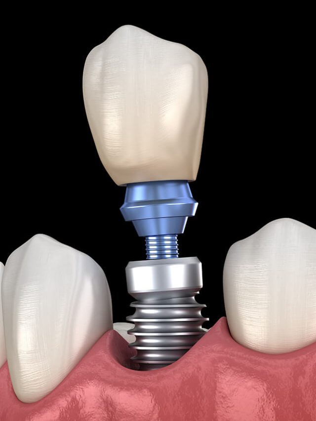 Do You Know the Benefits of Dental Implants?