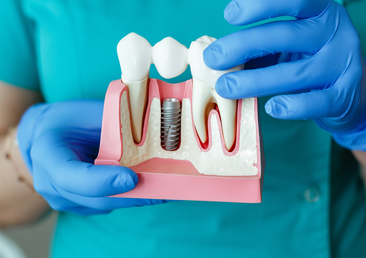 Dental Implants for Missing Teeth in Oakland Area