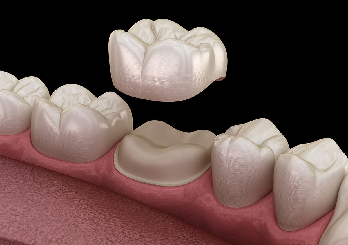 Dental Crowns for Front Teeth in Oakland CA Area